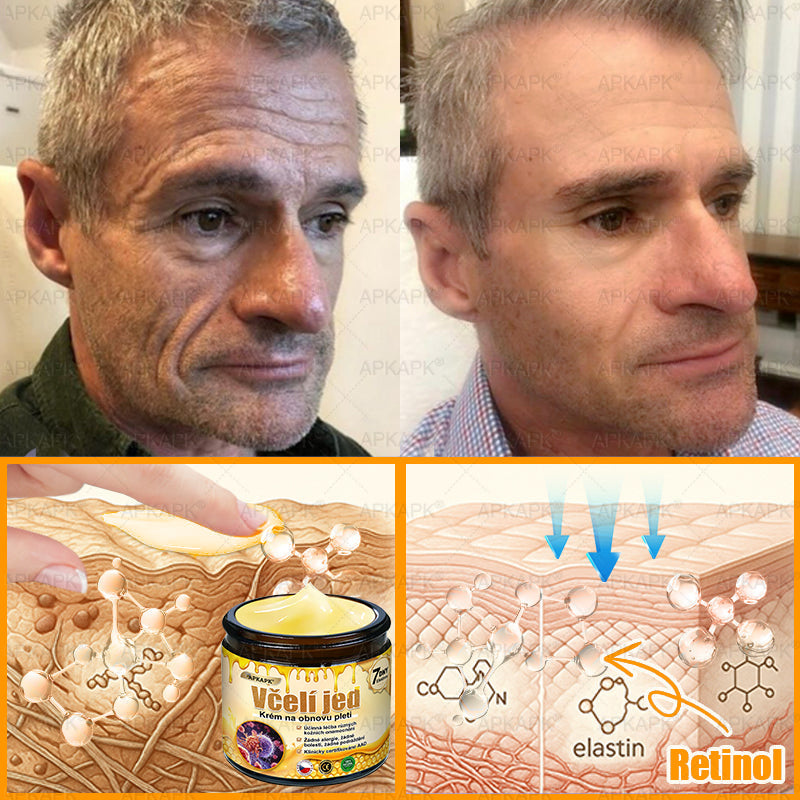 𝖠𝖯𝖪𝖠𝖯𝖪® 🐝 Krém s včelím jedem na obnovu pokožky 🐝 pomáhá při řešení kožních problémů, jako jsou: vrásky, jizvy, pigmentové skvrny, strie, akné, lupénka, ekzém, kožní léze, podráždění, záněty a další kožní potíže.